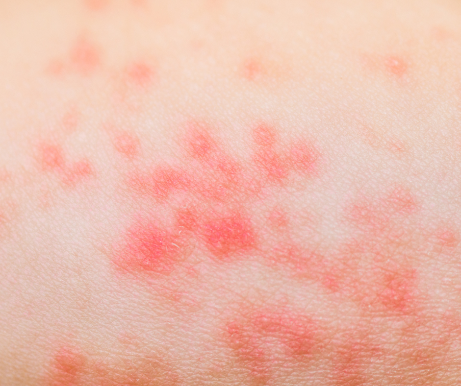perioral-dermatitis-dermatology-and-surgery-associates-bronx-new-york-2