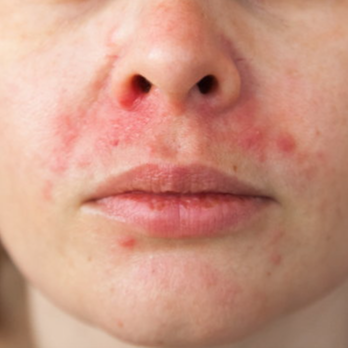 perioral-dermatitis-dermatology-and-surgery-associates-bronx-new-york