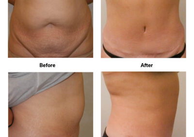 Abdominoplasty/Tummy Tuck