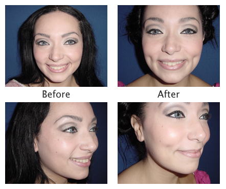 what-is-dimpleplasty-and-how-does-it-work-bronx-plastic-surgery-nyc-dimple-before-and-after-photo-1 bronx plastic surgery close up of dimples bronx ny