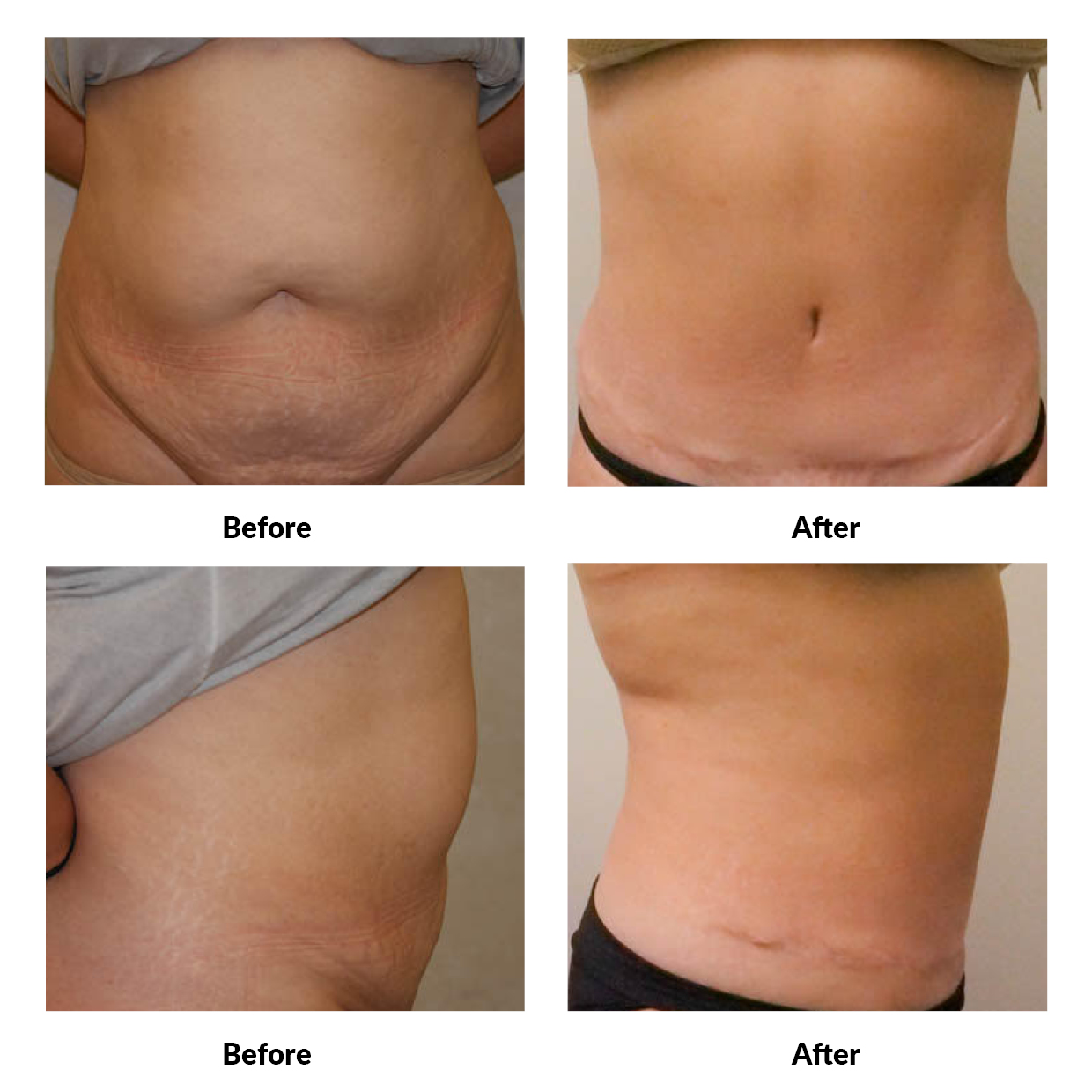 dermatology and surgery associates tummy tuck before and after bronx ny dermatology and surgery associates tummy tuck before and after bronx ny