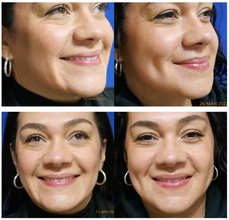 dermatology and surgery associates dimple surgery creation before and after bronx ny dermatology and surgery associates dimple surgery creation before and after bronx ny