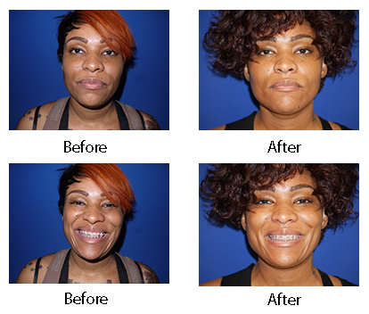dermatology & surgery associates dimple plastic surgery before and after bronx ny dermatology & surgery associates dimple plastic surgery before and after bronx ny