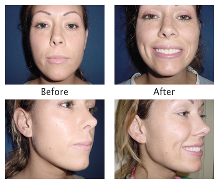 dermatology and surgery associates dimple surgery before and after bronx ny